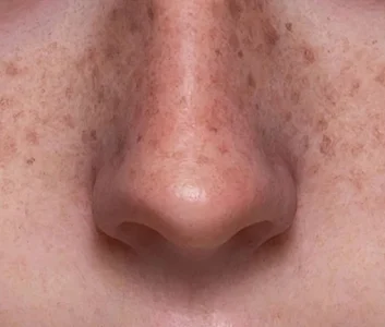 皮肤纹理 Skin texture of Face freckle